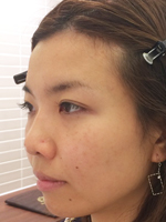 施術前がこちら