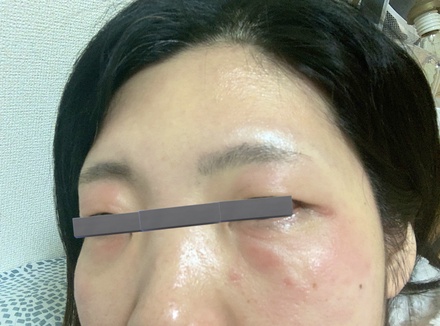 化粧品かぶれ の画像