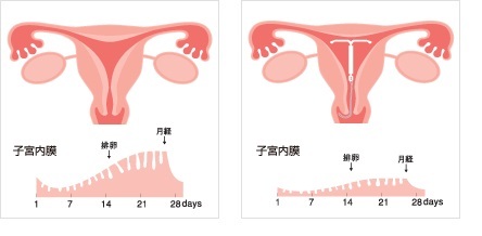 Pms ミレーナ