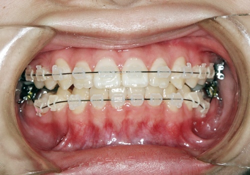 笑顔美人 をあきらめない 大人の歯科矯正 の3大ハードルにお答え ご説明します A Beauty By Cosme